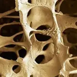 Quién descubrió la osteoporosis y su impacto en la salud ósea