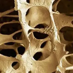 Quién descubrió la osteoporosis y su impacto en la salud ósea